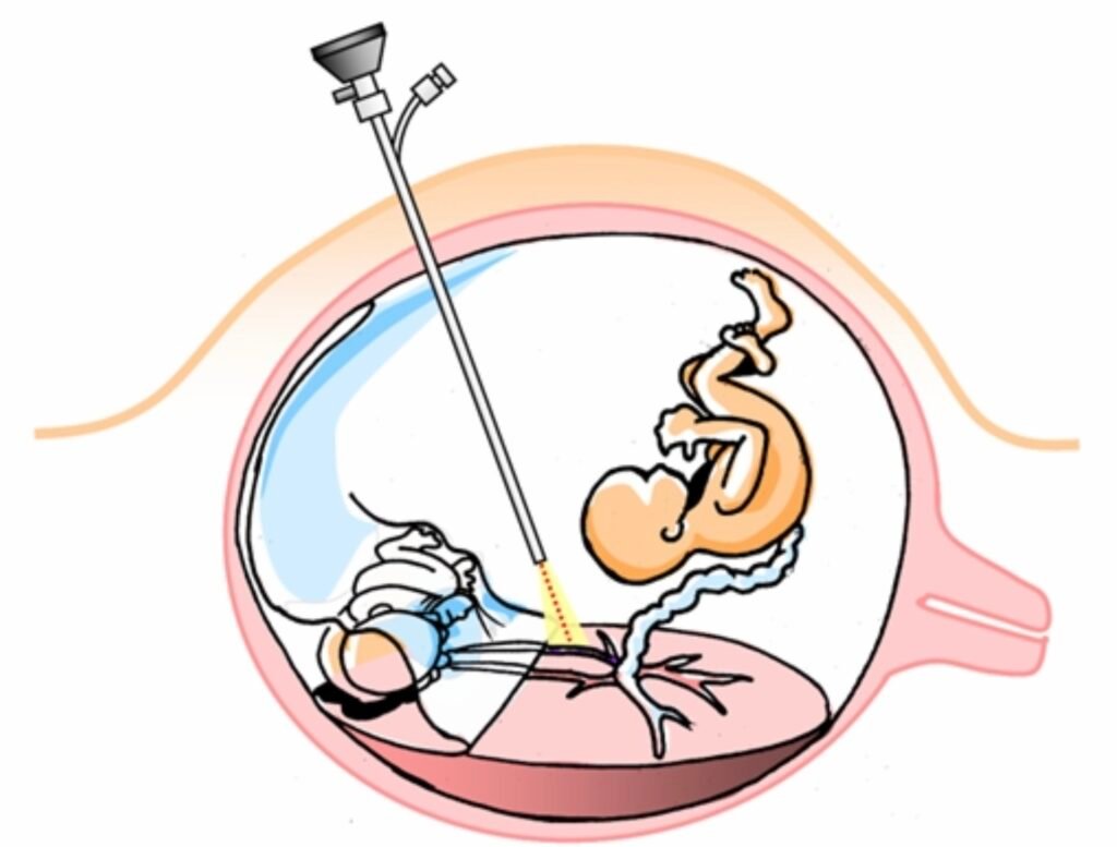 5 Things You May Not Know About Fetal Surgery